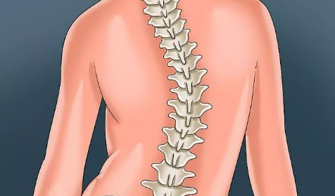 脊柱侧弯的四个自愈动作-脊柱侧弯术后一辈子禁忌