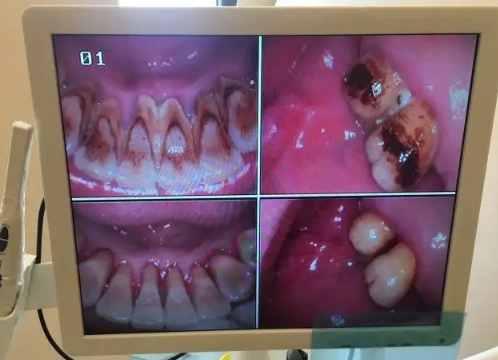 牙结石0度到3度的图-牙结石怎么分几度