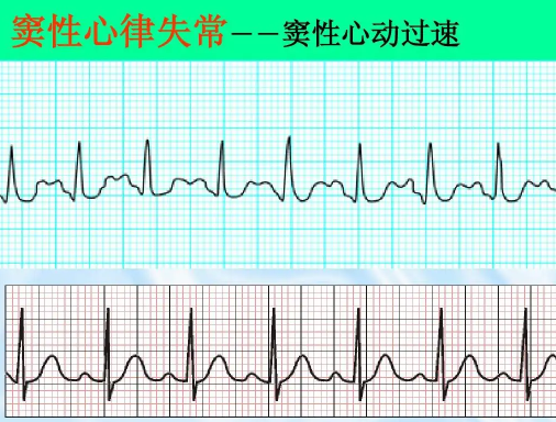 窦性心律不齐是心脏病早期吗-窦性心律不齐需要治疗吗