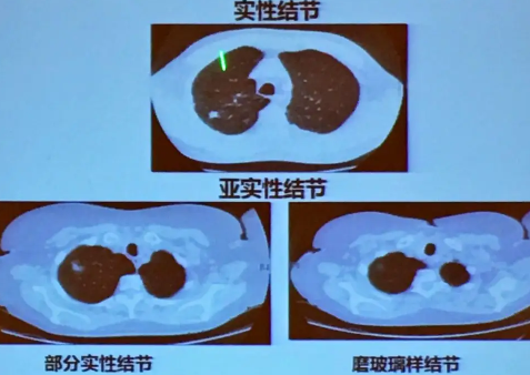 肺结节吓坏了多少年轻人-肺结节要随访一辈子吗