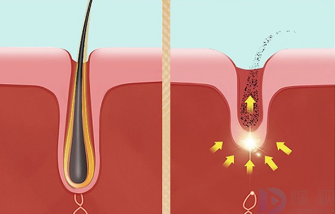 激光脱毛原理
