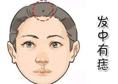面部痣好坏一览表图解 脸上哪些痣不能去掉图解