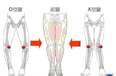 5种走路姿势会让你变成O型腿，走路姿势能改变o型腿吗