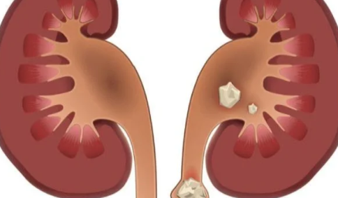 肾结石3mm×3mm多大_肾结石3mm严重吗