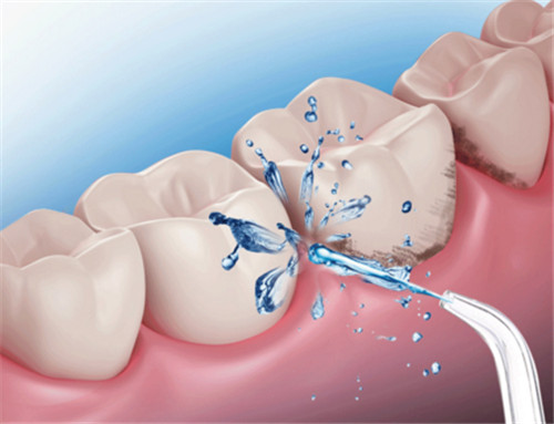 冲牙器的危害表现在几个方面 如何正确选择冲牙器