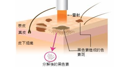 怎样才能去痘疤（痘疤原理和具体解决办法）