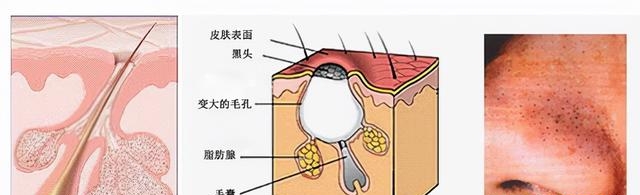 刷酸后黑头全冒出来了可以挤吗（新手在家刷酸有3个注意事项）