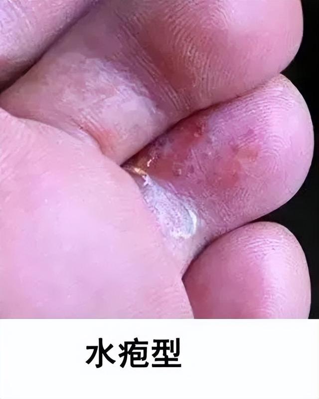 脚底水泡是什么原因引起的（脚上起小水泡很痒的原因）