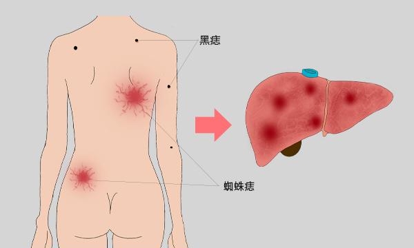 身体出现红色的小血痣什么原因（皮肤突然出现很多小红点的原因）