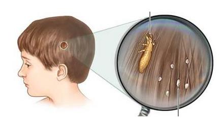 虱子卵用篦子梳不下来怎么办（去虱子和虱子卵的方法大全）