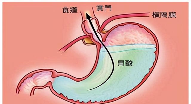 恶心吐酸水是什么原因造成的（泛酸时的饮食方注意事项）