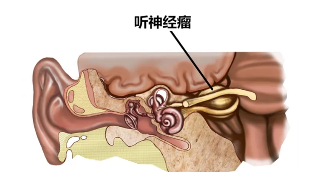 忽然耳鸣是什么原因引起的（突然耳鸣的5个原因）