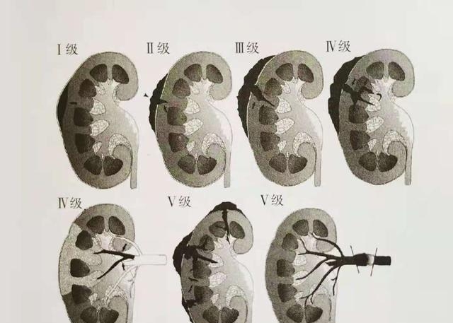 人体肾在哪个位置呢（教你迅速判断肾损伤情况）