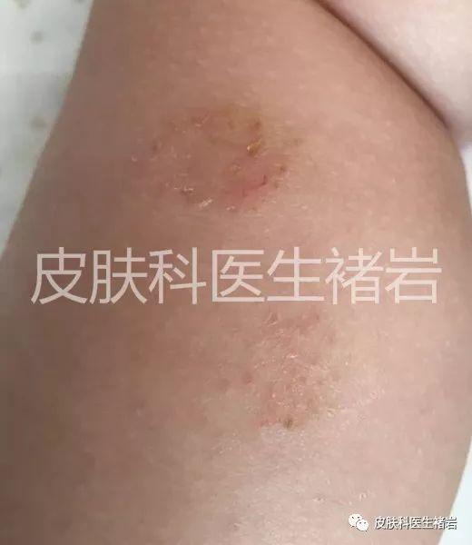 湿疹是什么样的（不同阶段湿疹的表现图片）